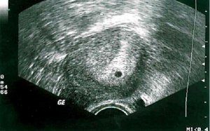 беременность при приеме дюфастона.jpg