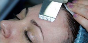 лазерная чистка лица