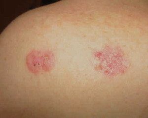 базалиома фото