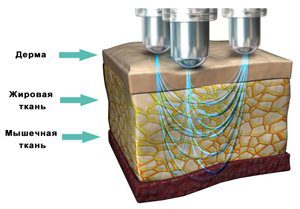 воздействие rf импульсов