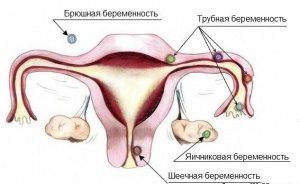 лечение при внематочной беременности