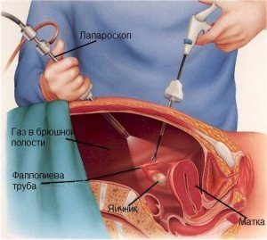 лапароскопия при внематочной беременности