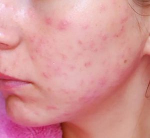 аллергические прыщи