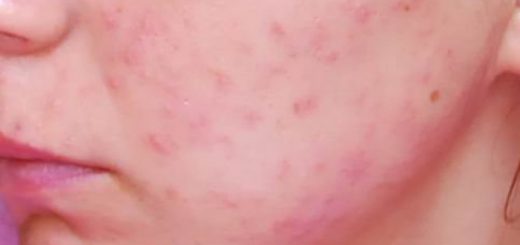 аллергические прыщи