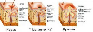 типы прыщей