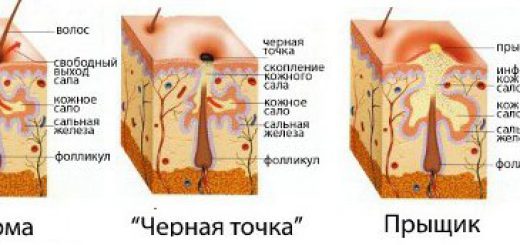 как возникают черные точки