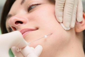 подтяжка лица мезонитями