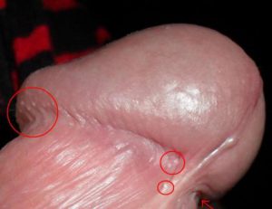 прыщ на головке фото