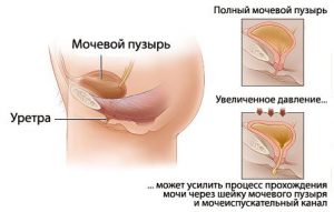 недержание мофчи фото