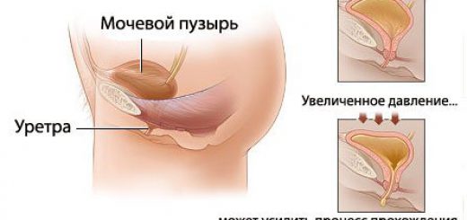 недержание мофчи фото
