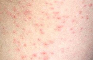 сыпь у ребенка