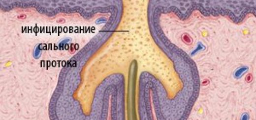 комедоны причины фото