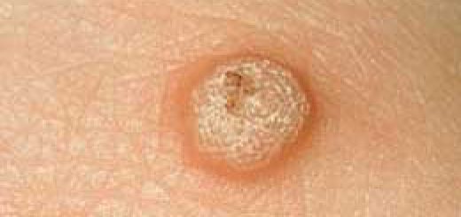 вульгарная бородавка