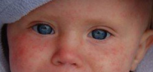 аллергическое высыпание у ребенка на лице фото