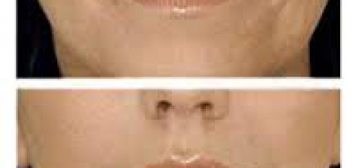 до и после шлифовки лица фото