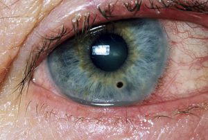 24-princ_rm_photo_of_eye_with_corneal_abrasion.jpg