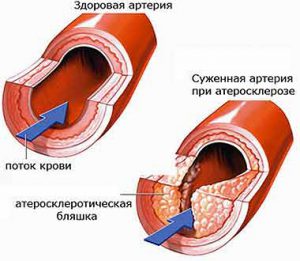 ateroskleroz-folk-medicine.jpg