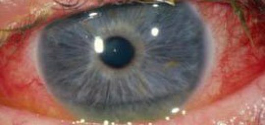 conjunctivitis_bacterial.jpg