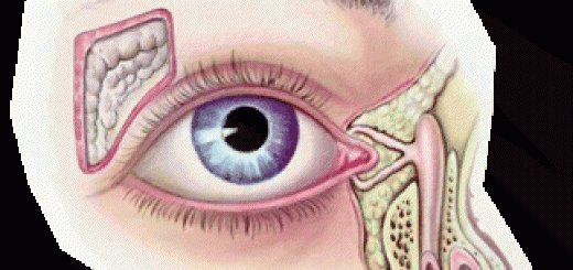 dacryo1.gif