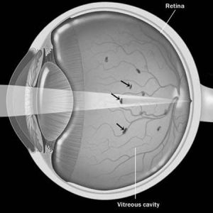 destruction-of-the-vitreous-eye-floaters-1231.jpg