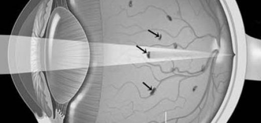 destruction-of-the-vitreous-eye-floaters-1231.jpg