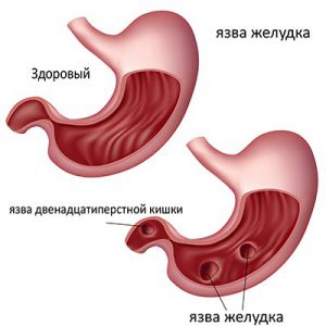 yazva-zheludka-helicobacter-pylori1.jpg