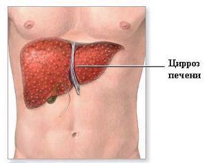 simptomy-cirroza-pecheni.jpg