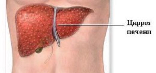 simptomy-cirroza-pecheni.jpg