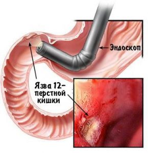 ulcer-of-duodenum-1.jpg