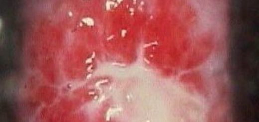 1327117477_chlamydia-in-women.jpg