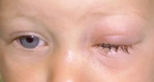 аденовирусный конъюнктивит