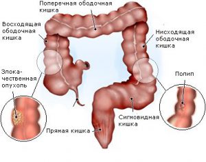 полипы в кишечнике