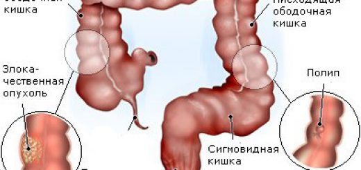 полипы в кишечнике
