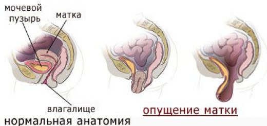 опущение матки