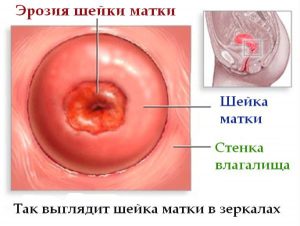 эрозия