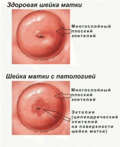 шейка матки