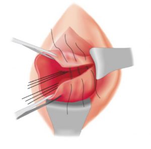 зашивание разрыва