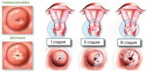 последствия разрыва