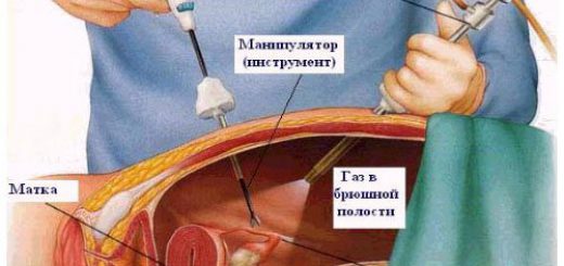удаление матки лапароскопия