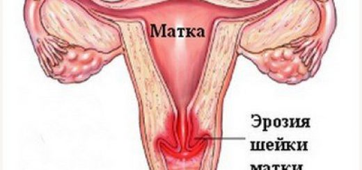 эрозия шейки матки.jpg