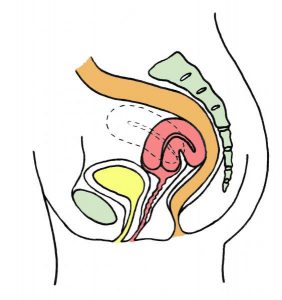 изгиб матки