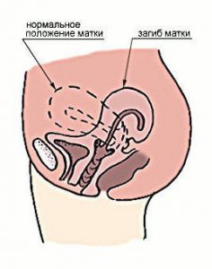 Ретрофлексия матки.jpg