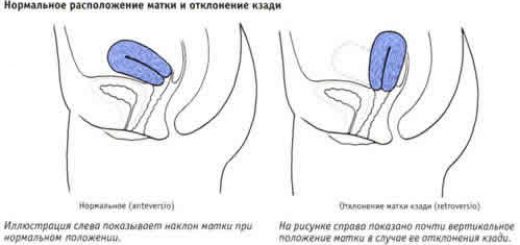 ретродевиация матки