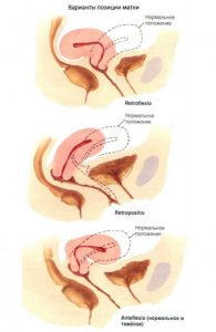 загиб матки