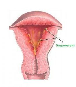 Эндометрит.jpg
