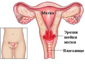 Эрозия матки.jpg