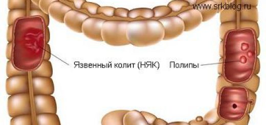 Язвенный колит.jpg