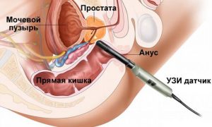 узи простаты