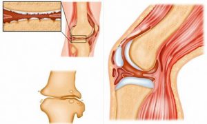 туберкулез костей.jpg
