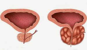 Застойный простатит.jpg